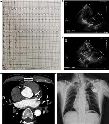 Atrial Lesions in a Pedigree With PRKAG2 Cardiomyopathy: Involvement of Disrupted AMP-Activated Protein Kinase Signaling